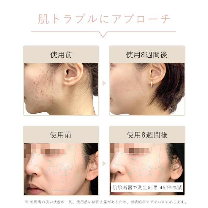 [レンタル] STELLA BEAUTE(ステラ ボーテ) IPL光美容器 Luna - 12