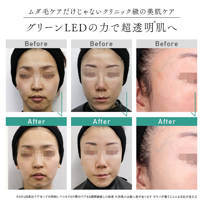 [レンタル] STELLA BEAUTE(ステラ ボーテ) IPL光美容器 SB-IFD03 - 13