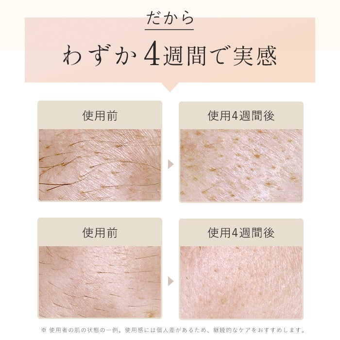 [レンタル] STELLA BEAUTE(ステラ ボーテ) IPL光美容器 Luna - 10