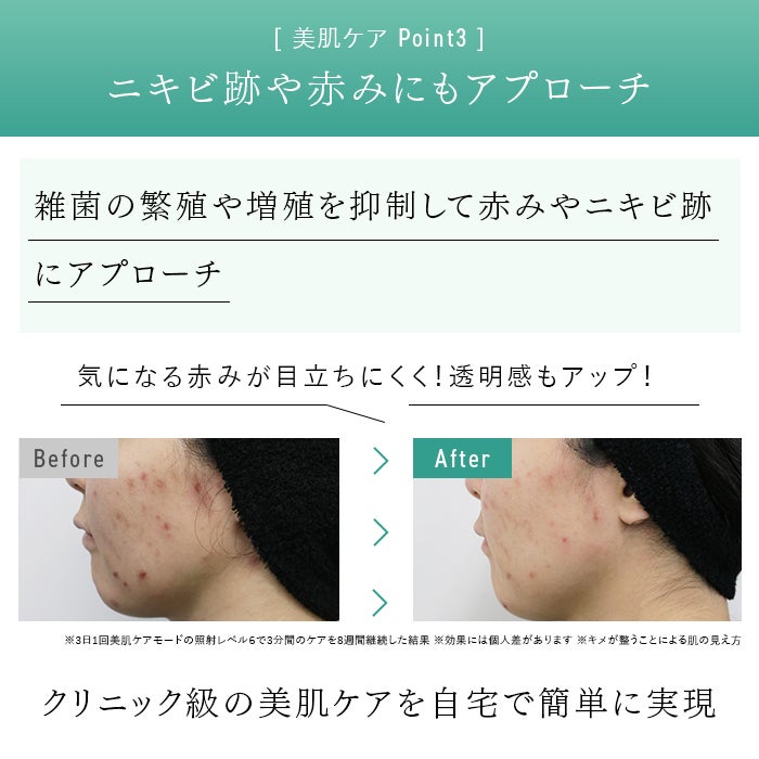 レンタル] STELLA BEAUTE(ステラ ボーテ) IPL光美容器 SB-IFD03