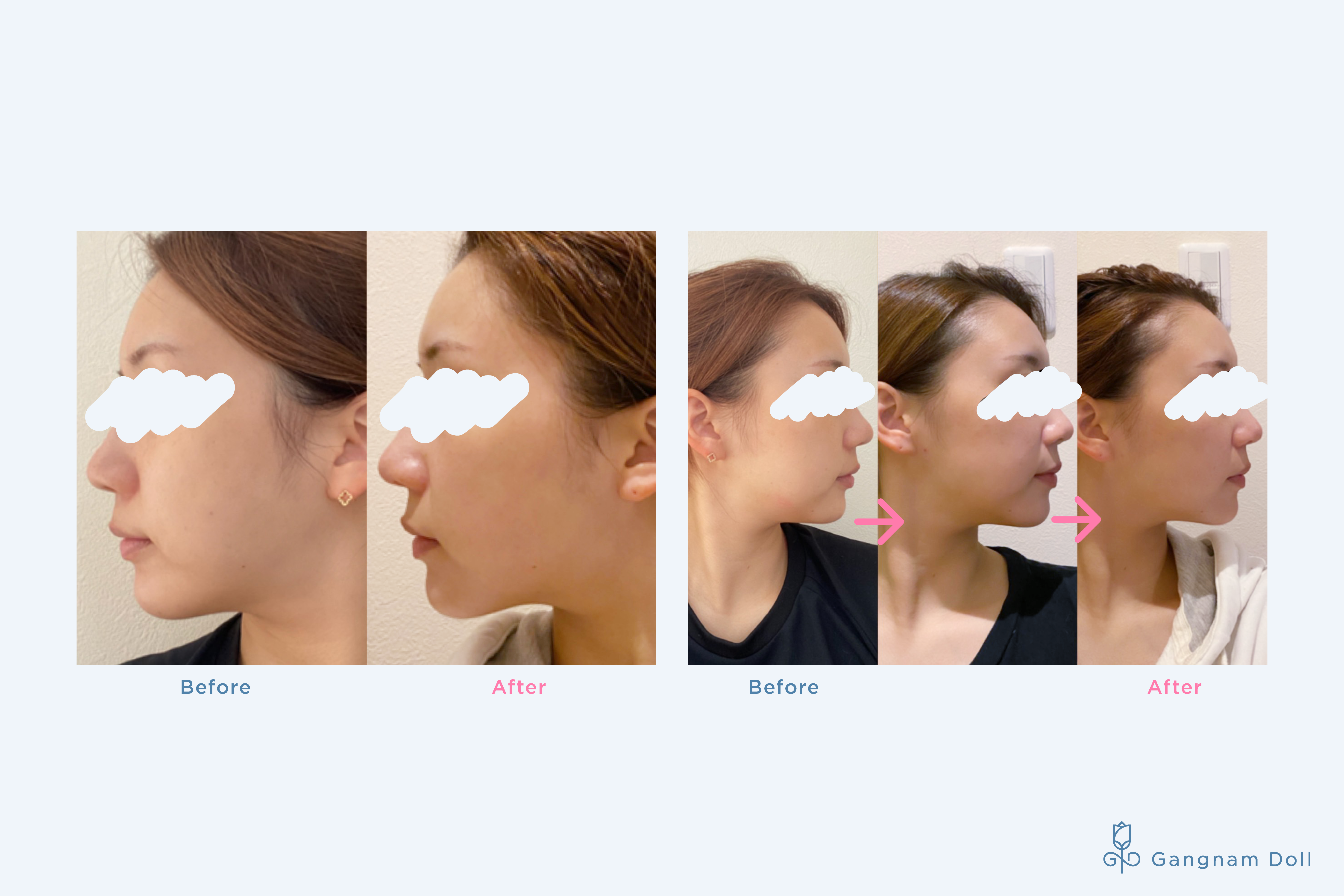 再入荷☆ 大大特価セール☆韓国発の美顔器「ELFACE（エルフェイス